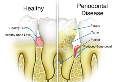 Healthy Gums and Teeth vs. Periodontal Disease