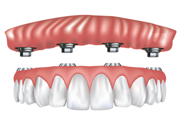 Implant Supported Dentures