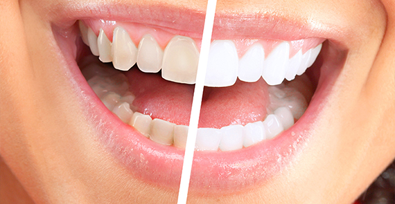Laser Teeth Whitening Results